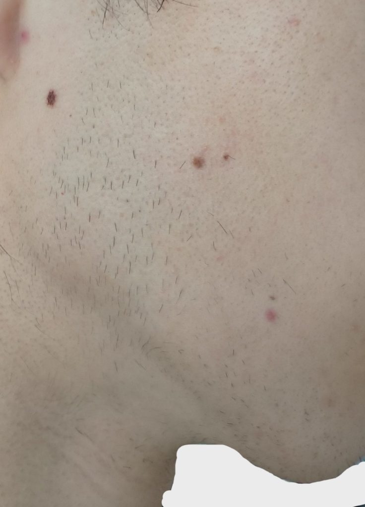 右もみあげ１２回目脱毛開始直前の剃毛１週間後